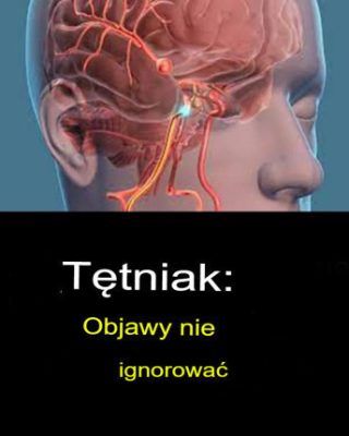 Tętniak mózgu – objawy, których nie wolno ignorować