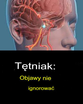 Tętniak mózgu – objawy, których nie wolno ignorować