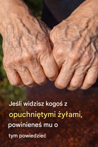 Niebieskie żyły na skórze: dlaczego się pojawiają, kiedy należy się martwić i jak dbać o zdrowie naczyń krwionośnych