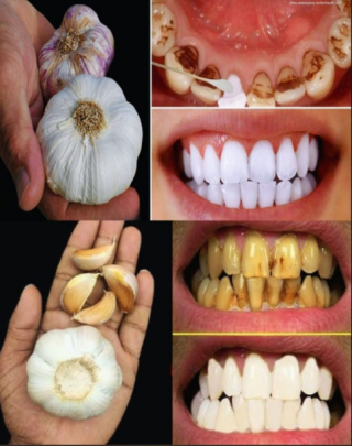 Tajemniczy dentyści nie chcą, żebyś się dowiedział: usuń kamień nazębny i wybiel zęby w zaledwie 2 minuty za pomocą czosnku!