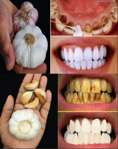 Tajemniczy dentyści nie chcą, żebyś się dowiedział: usuń kamień nazębny i wybiel zęby w zaledwie 2 minuty za pomocą czosnku!
